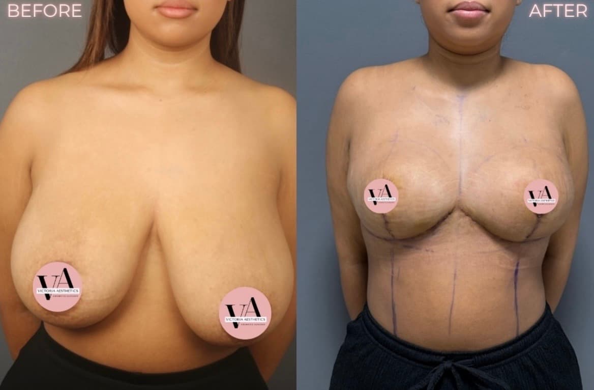 Breast