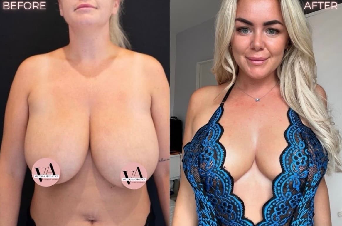 Breast