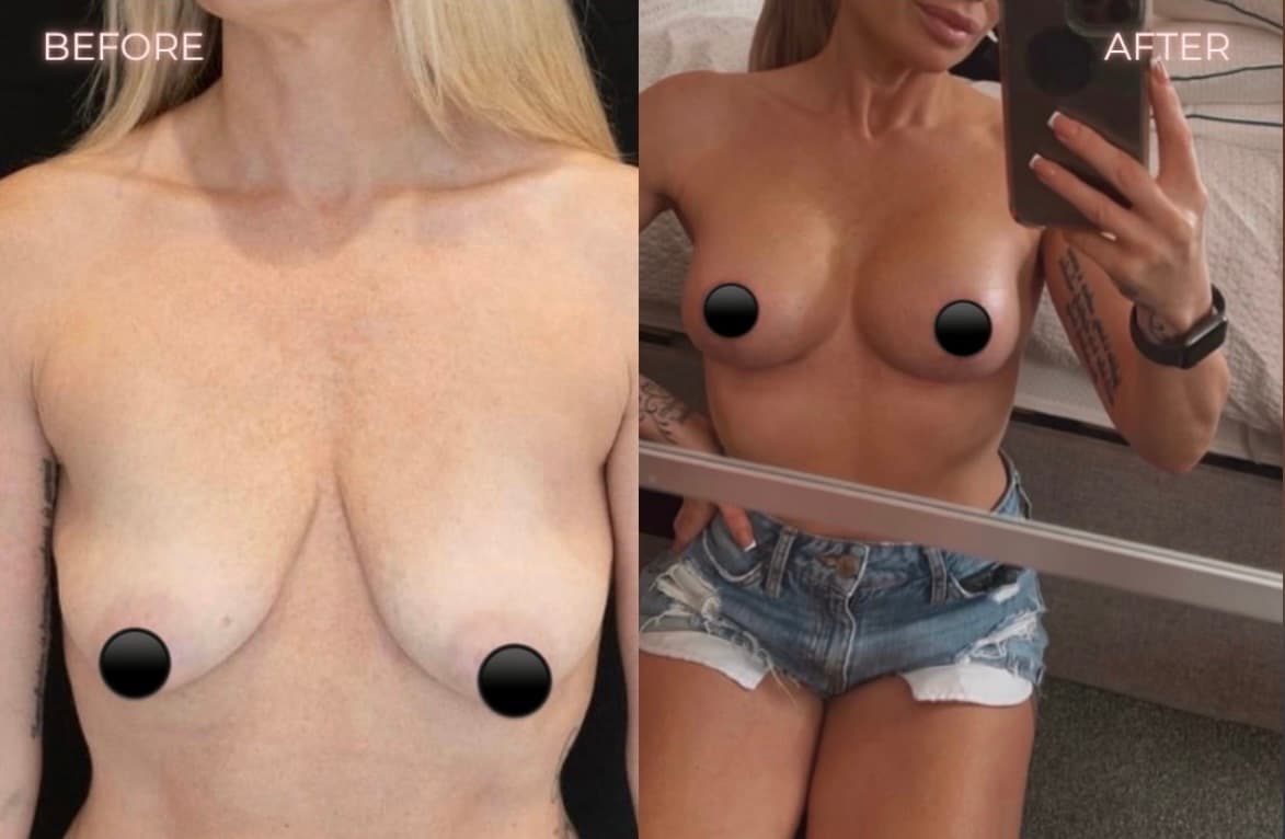 Breast