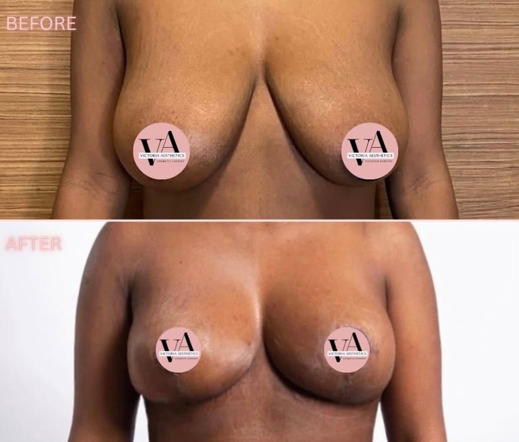 Breast