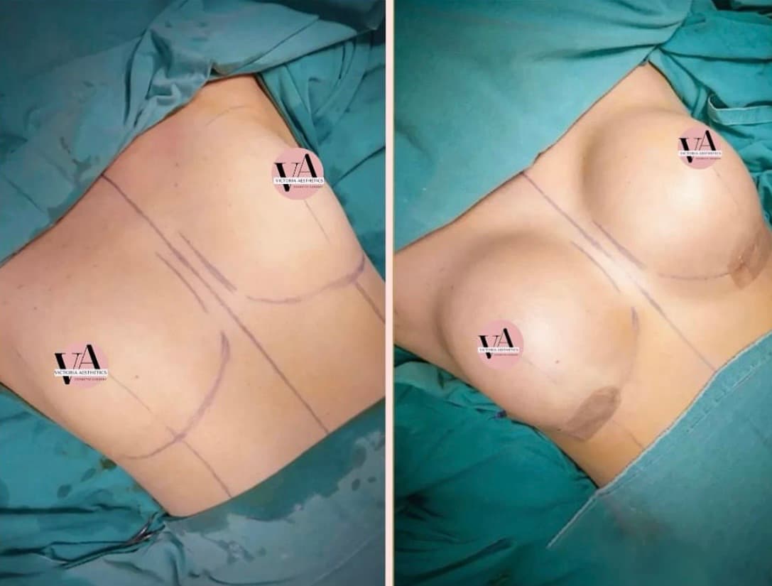 Breast