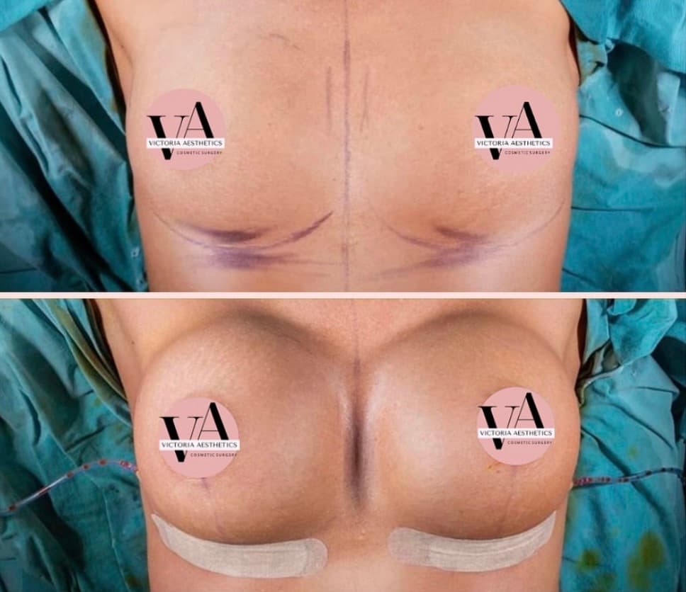 Breast
