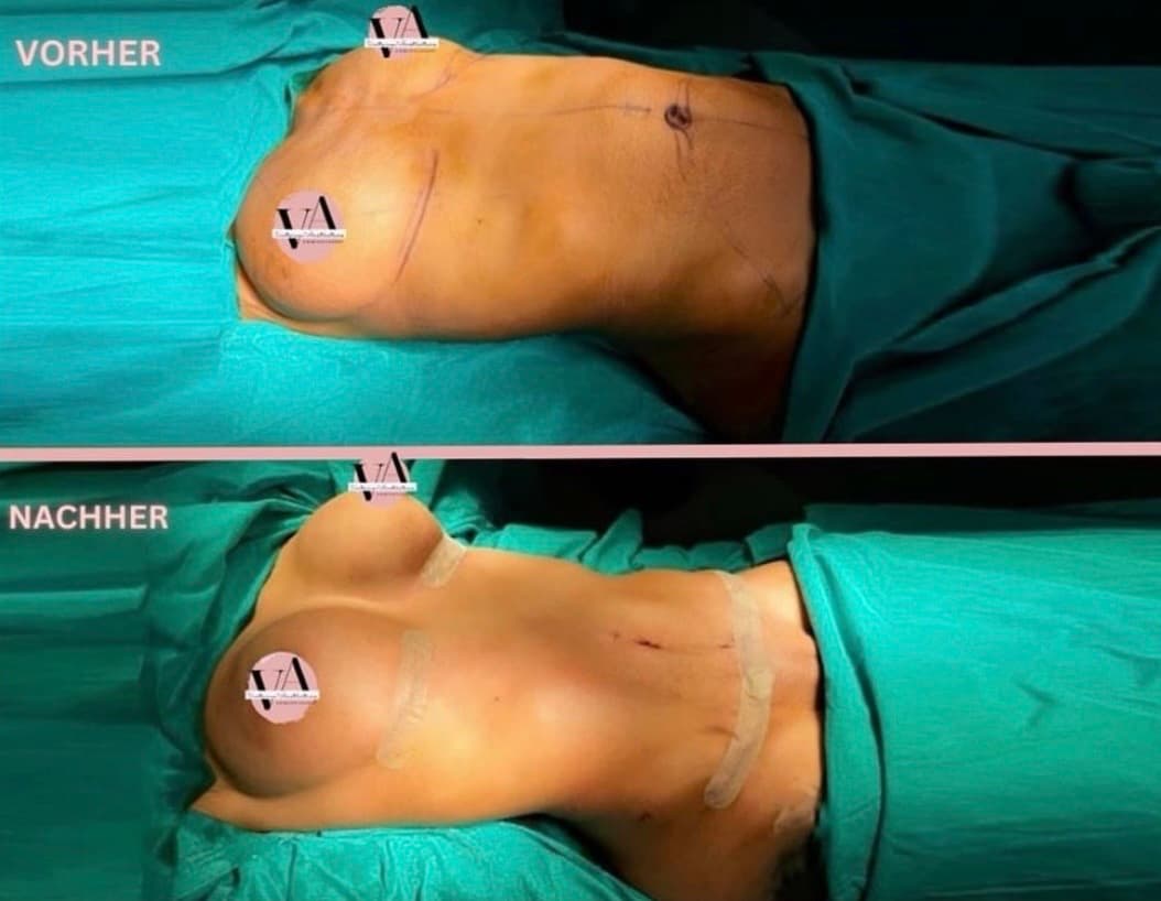Breast