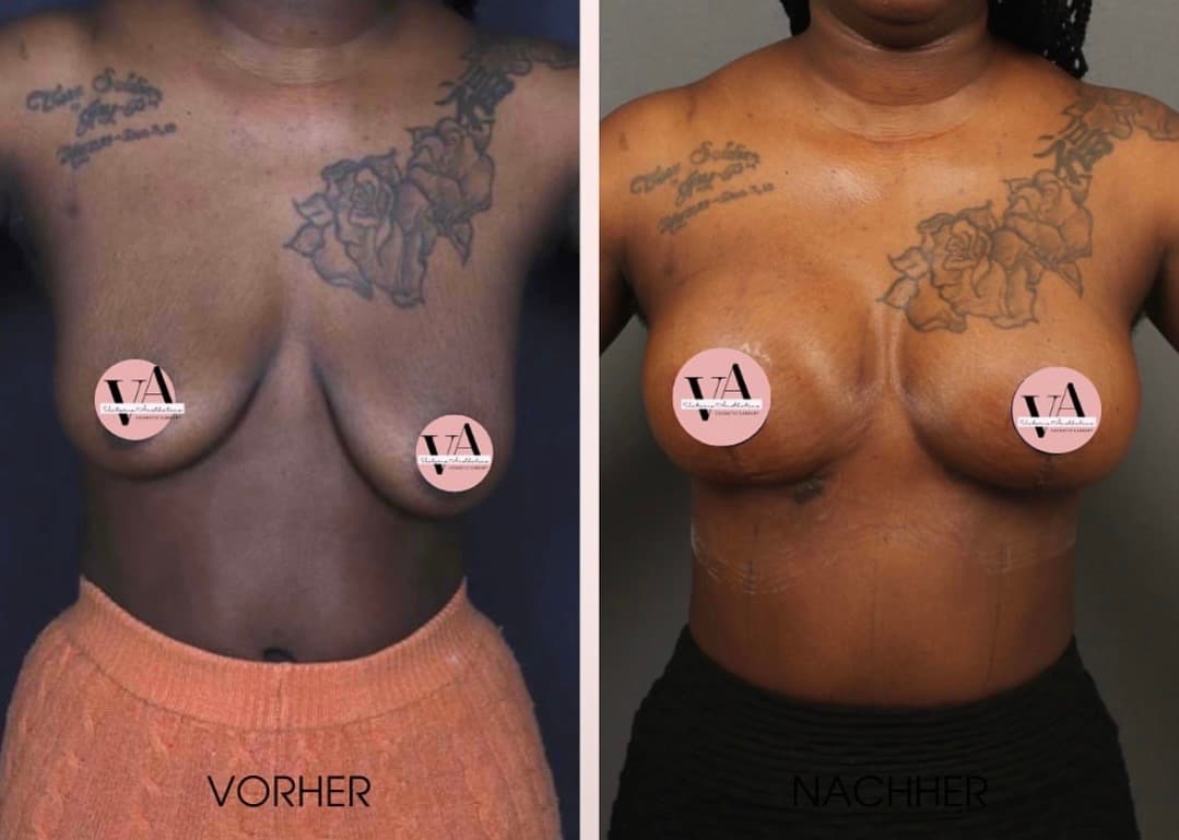 Breast