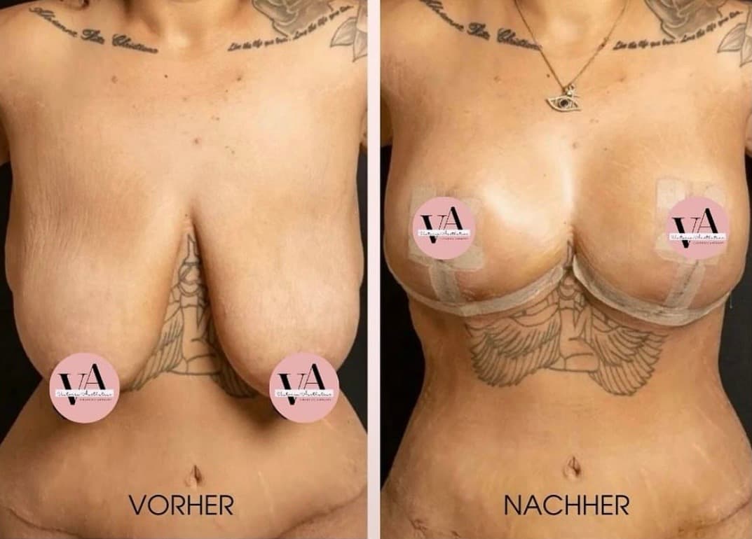 Breast