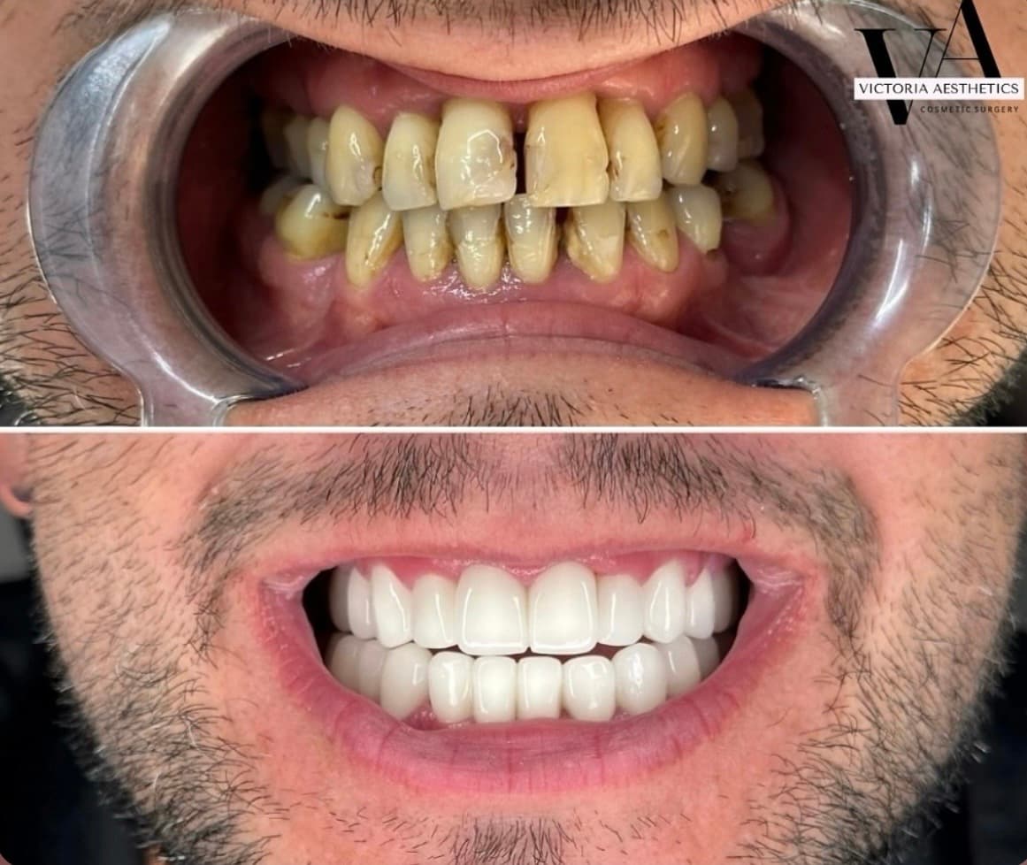 Dental aesthetics