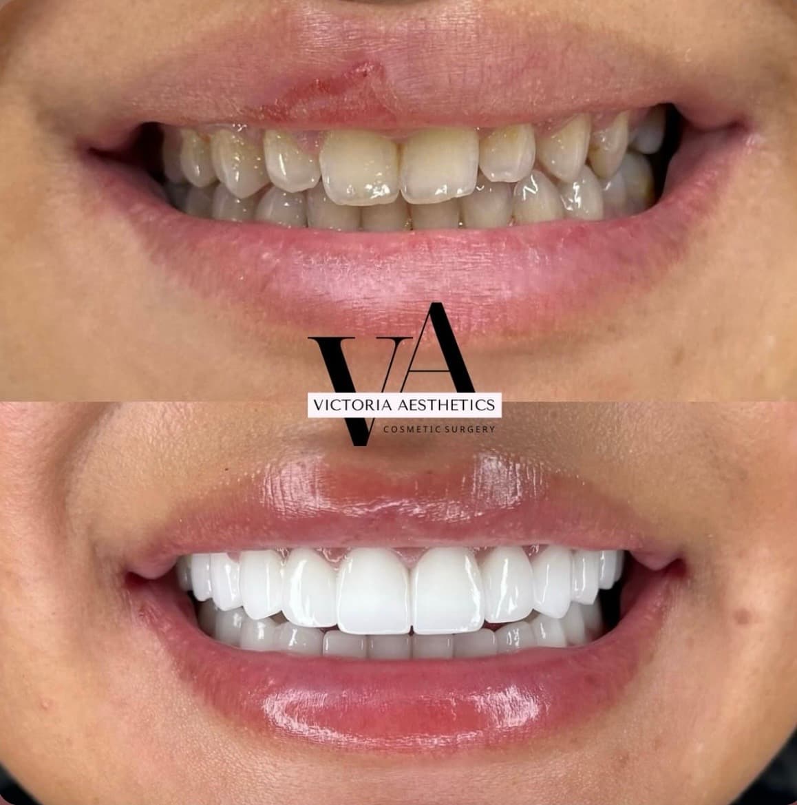 Dental aesthetics